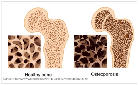 osteoporosis-tulang